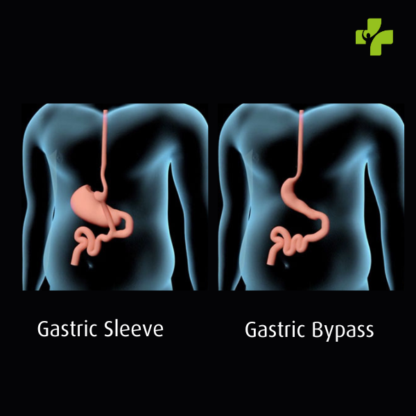 Difference Gastric Sleeve and Bypass Surgery